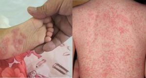 dị ứng nước sinh hoạt