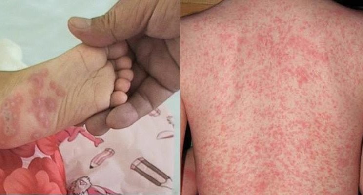 dị ứng nước sinh hoạt