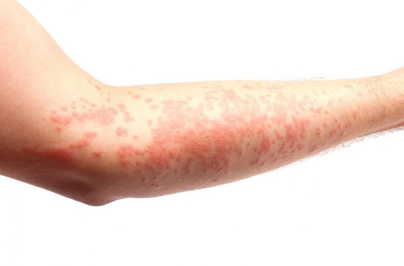 dị ứng nước sinh hoạt